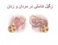 برداشتن زگیل تناسلی