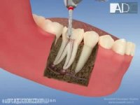 عصب کشی دندان