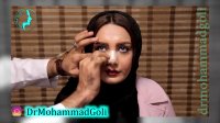 برداشتن چسب بینی پس از عمل توسط دکتر گلی