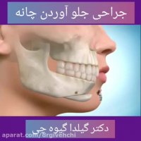 جراحی پروتز چانه (جلو آوردن چانه)