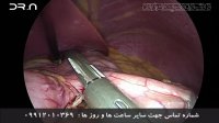 فیلم عمل جراحی لاپاراسکوپی اسلیو معده توسط دکتر داود نریمان زاده