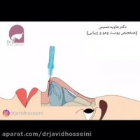 لیفت بینی با نخ