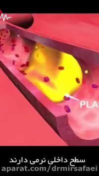 انیمیشن سکته قلبی