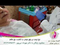 نخ لیفت و رفع غبغب با کاشت نخ pdo