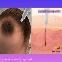 فیلم واقعی از نحوه کاشت مو