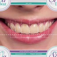 طراحی لبخند | دندانپزشکی سیمادنت