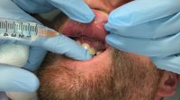 gum abscess drainage - Full VIDEO