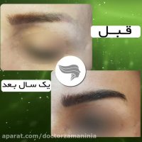 فیلم نمونه کاشت ابرو یکسال بعد
