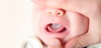 علت برفک دهان نوزاد