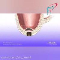 جراحی سینوس لیفت