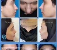 نمونه کارهای عمل بینی دکتر نسرین راستا