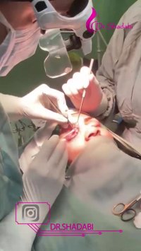 جراحی پلک بلافاصله بعداز عمل