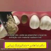 درمان دندان شکسته با روکش های زیبایی
