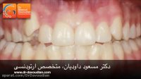دندان نیش بیرون زده | دکتر مسعود داوودیان