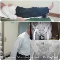 معاینه بیمار 45 روز بعد از جراحی تعویض مفصل لگن