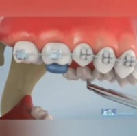 فیلم درمان ناهنجاری دندانی دیپ بایت