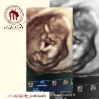 فیلم سونوگرافی nt