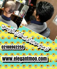 ترمیم موی الگانت /02188962259/پروتز مو