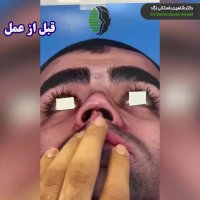 فیلم جراحی بینی ترمیمی