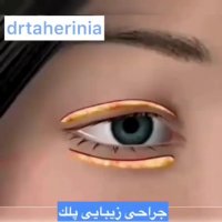 انیمیشن جراحی زیبایی پلک