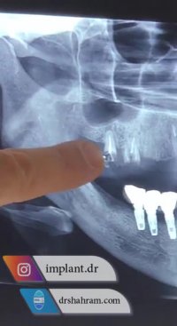 تقویت استخوان و کاشت 8 واحد ایمپلنت توسط دکتر شهرام اسعدی