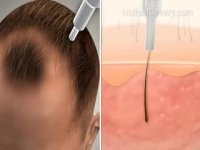 فیلم کاشت مو-کلینیک تخصصی رنسانس