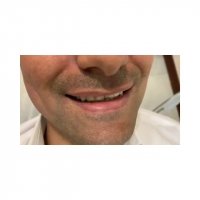 فیلم کامپوزیت ونیر