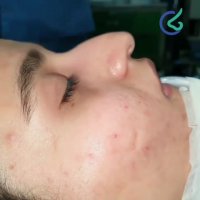 عمل بینی استخوانی و ترمیم انحراف شدید بینی