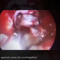 التهاب جیوب الفطریه