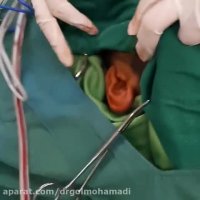 عمل جراحی اتوپلاستی