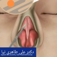 جراحی زیبایی بینی