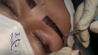 کاشت ابرو در کلینیک تخصصی آریامن