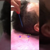 اسکالپ سر برای رفع کم پشتی و طاسی در آقایان