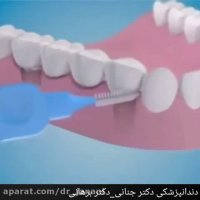 چگونه بریج دندان را تمیز کنیم؟؟؟