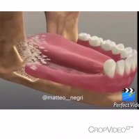 پیوند استخوان فک جهت ایمپلنت دندان