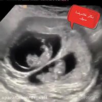 سونوگرافی بارداری دو قلو