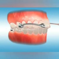 فیلم درمان بیرون زدگی دندانهای فک بالا