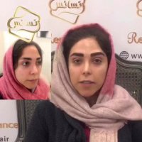 کاشت ابرو_تکنیک جدید کاشت ابرو کلینیک رنسانس