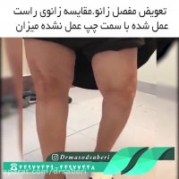 نتیجه عمل جراحی تعویض مفصل زانو | دکتر مسعود صابری متخصص ارتوپد