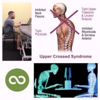 سندرم متقاطع فوقانی چیست؟
