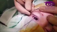 فیلم واقعی عمل افتادگی پلک مادرزادی شدید