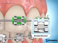 دکتر مسعود داودیان :: اجزاء دستگاه ارتودنسی ثابت