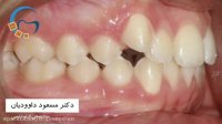 قبل و بعد ارتودنسی بدون کشیدن دندان | دکتر داوودیان