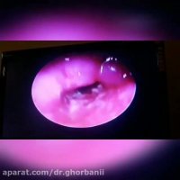 آندوسکویپک حنجره در بیمار مبتلا به سرطان حنجره