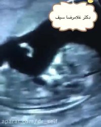 سونوگرافی جنین