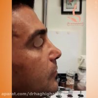 فیلم جراحی بینی در شیراز