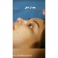 فیلم واقعی جراحی ترمیمی بینی از طبیعی به نیمه فانتزی