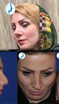 رضایت بیمار بیست و دو روز بعد از جراحی بینی