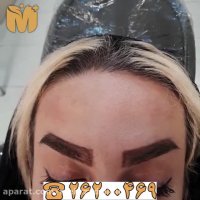 فیلم نمونه تزریق بوتاکس