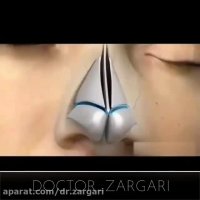 انیمیشن جراحی بینی